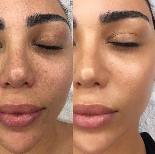 Before and after photos of a woman's face